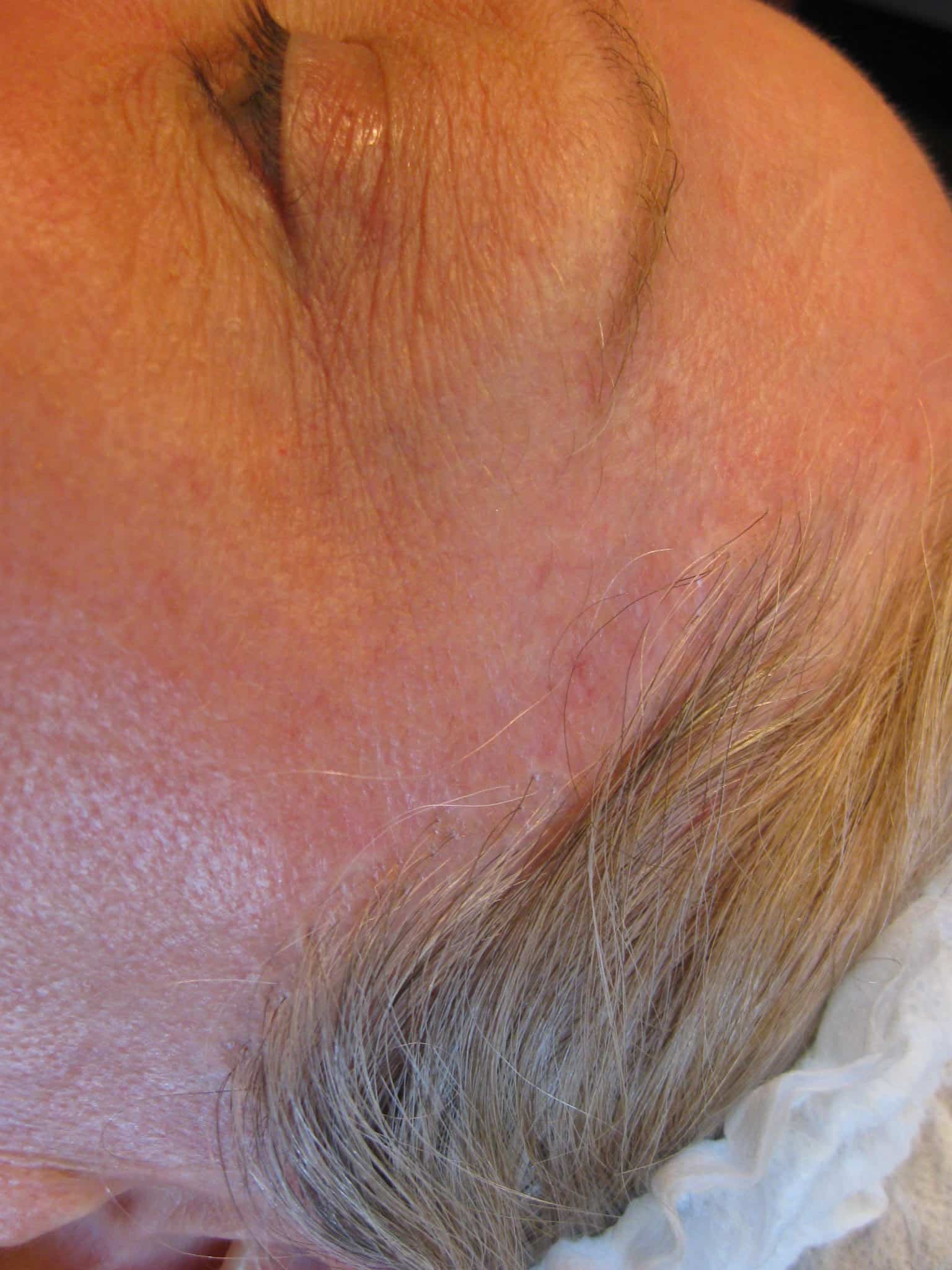 After Scar Repigmentation
