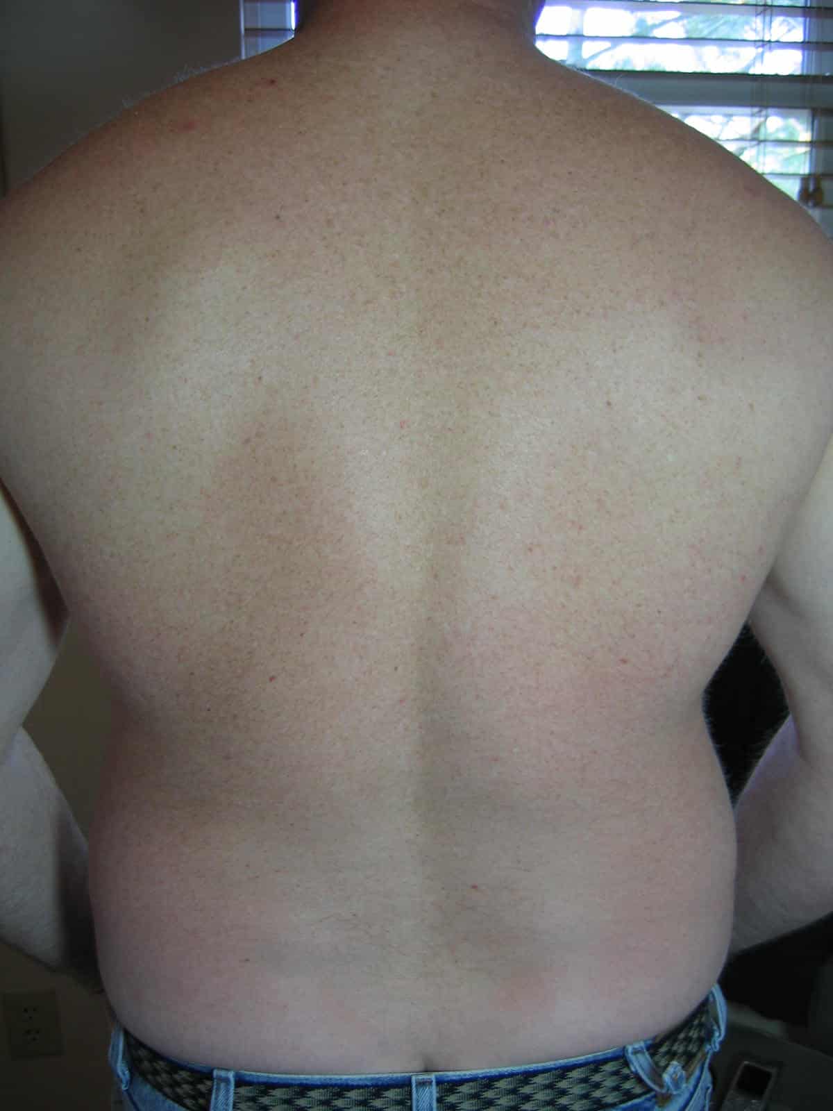 Back, after 4 treatments