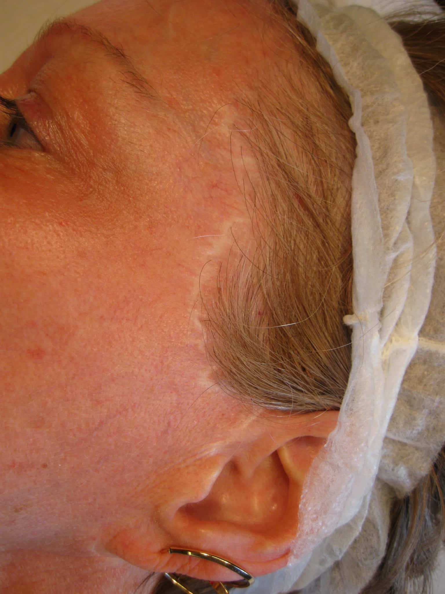 Before Scar Repigmentation