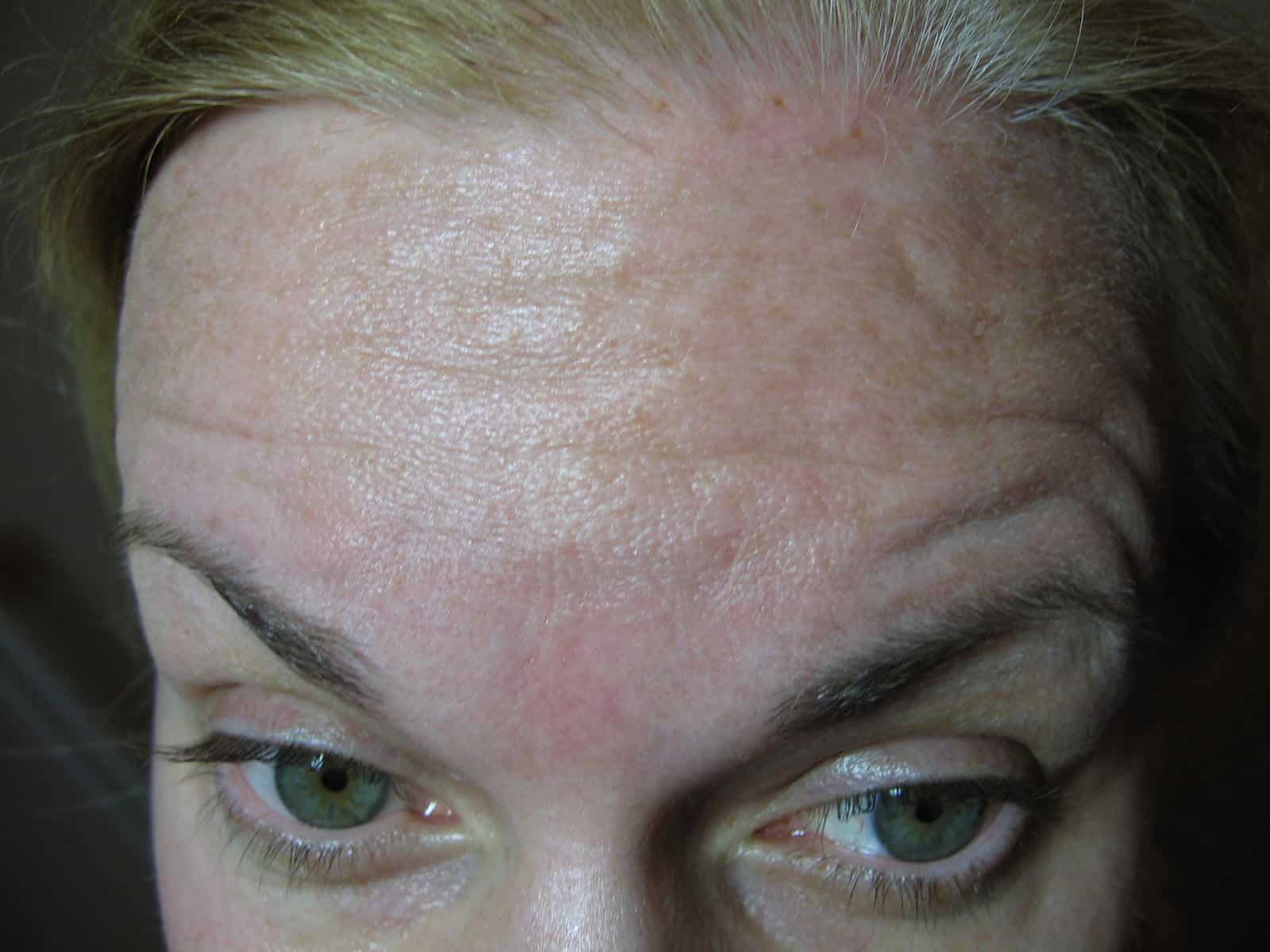 Frontalis, before