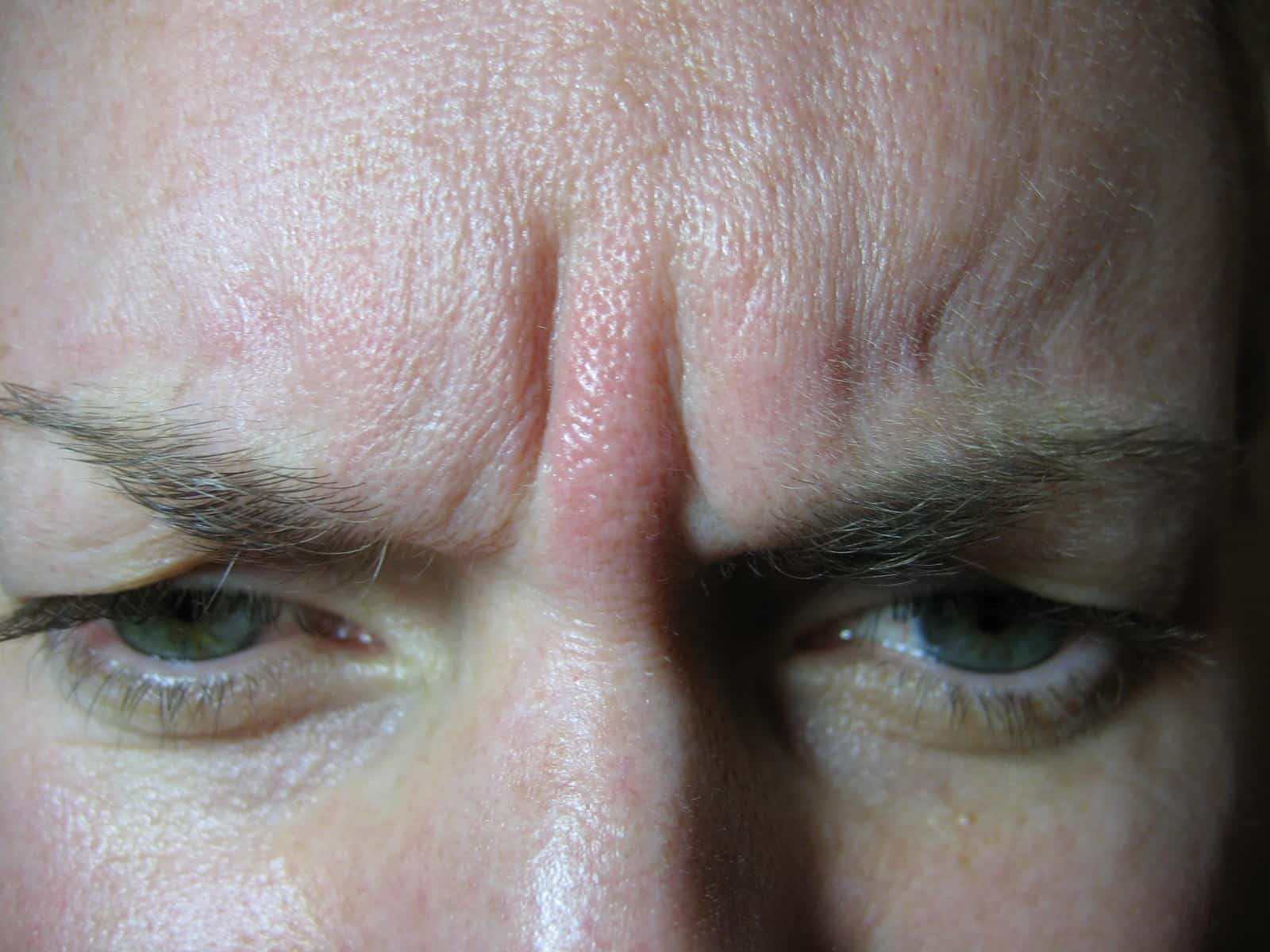 Glabella, before