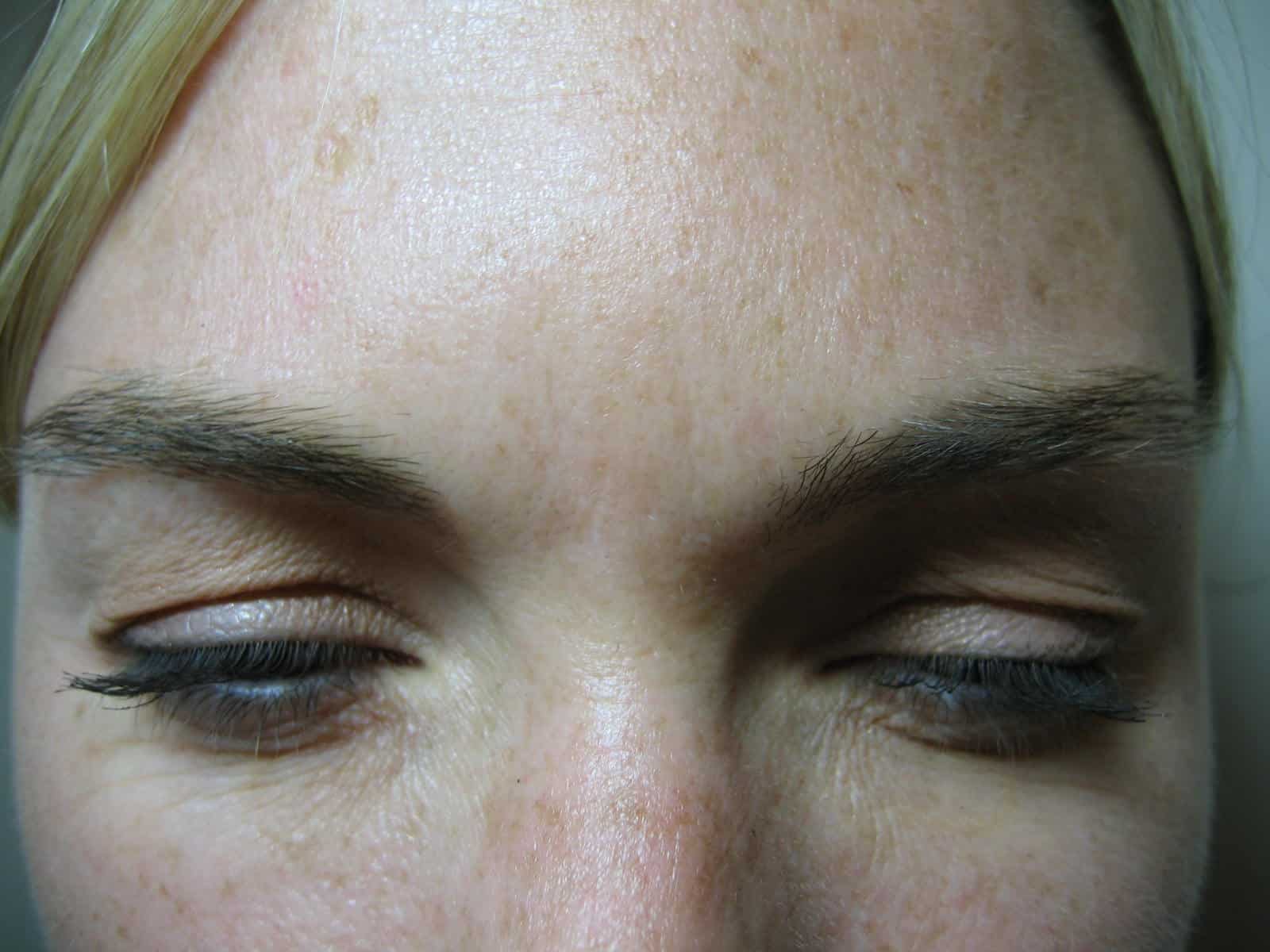 Glabella, post Botox