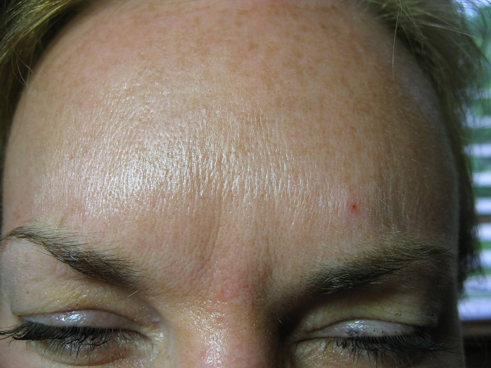 Glabella post Botox