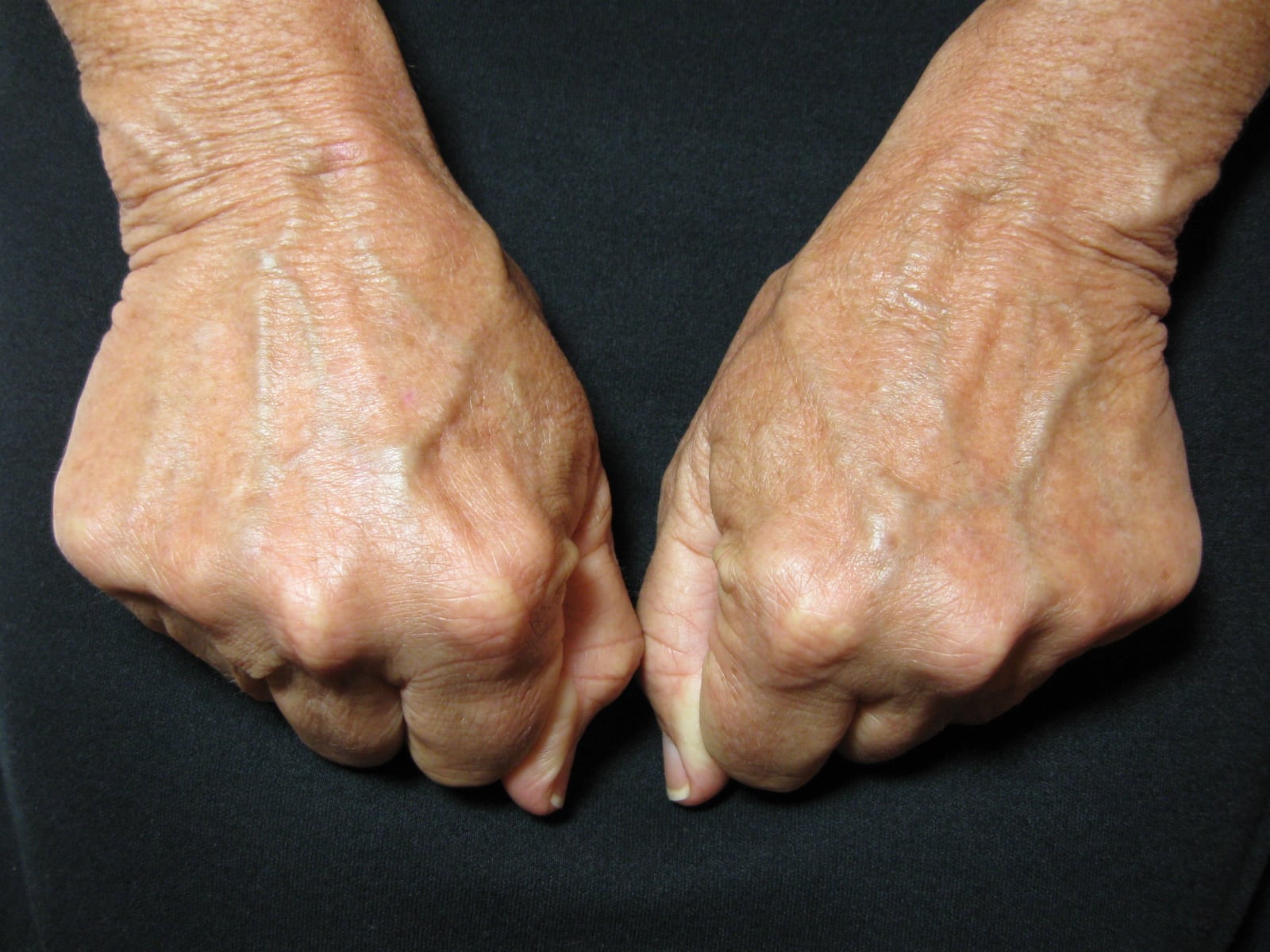 Hands, Post Radiesse