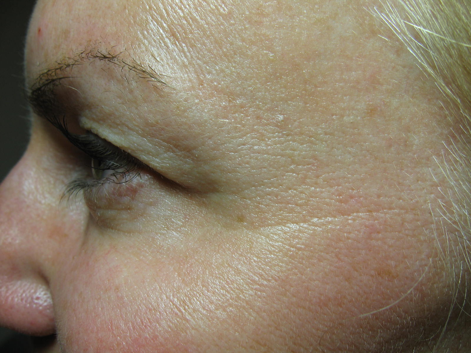 L Crow's feet, post Botox