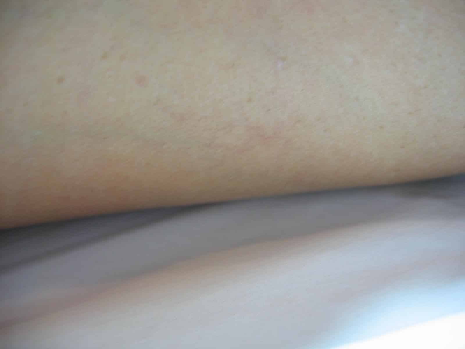 Left lateral thigh 3, after txt