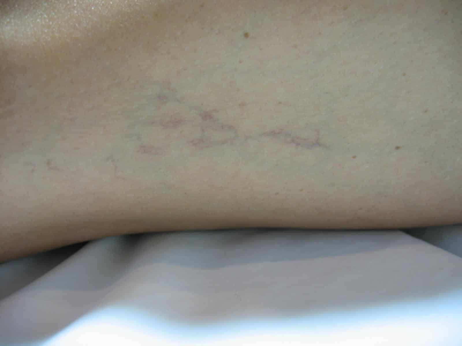 Left lateral thigh 3