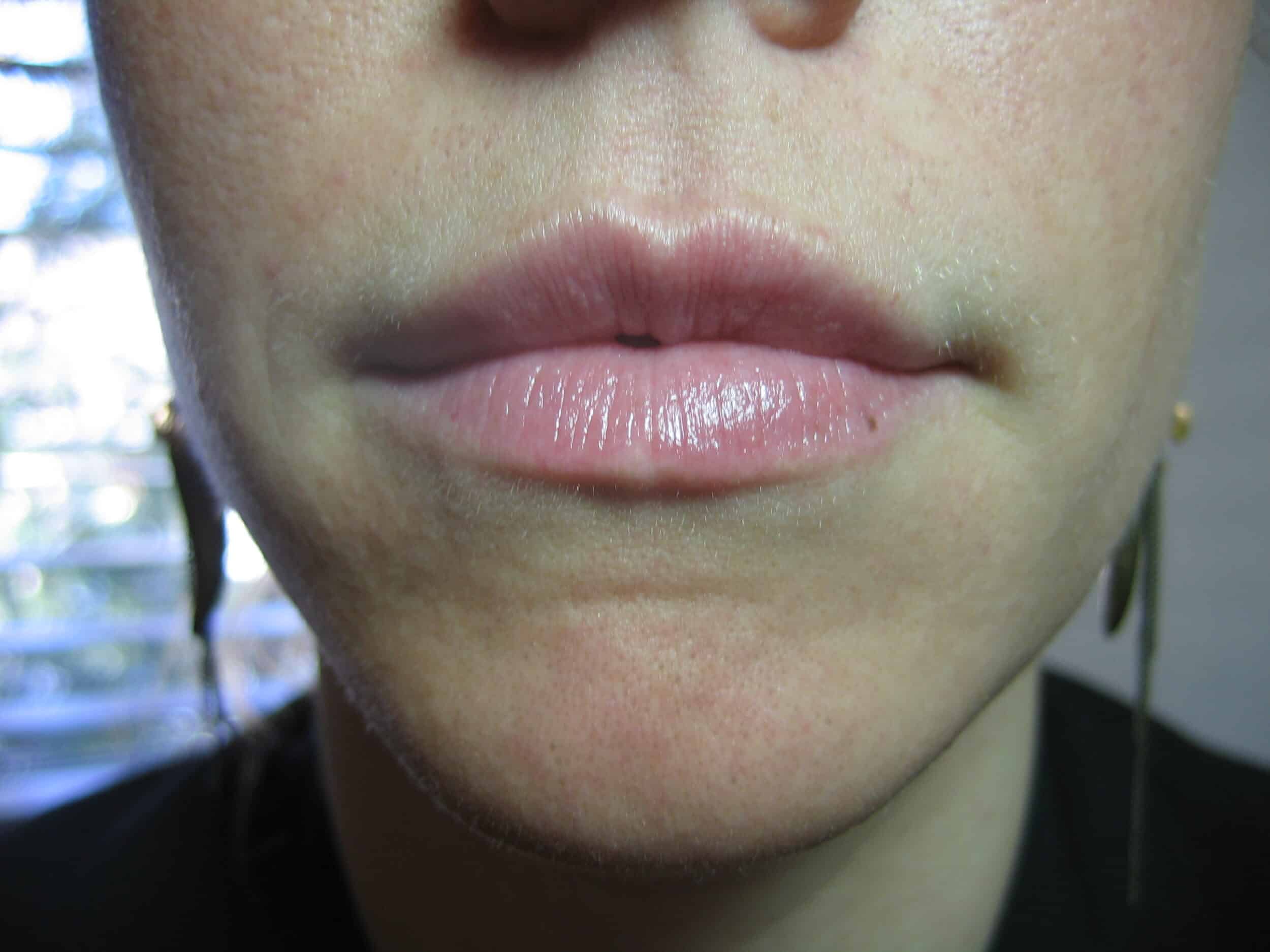 Post Restylane 1