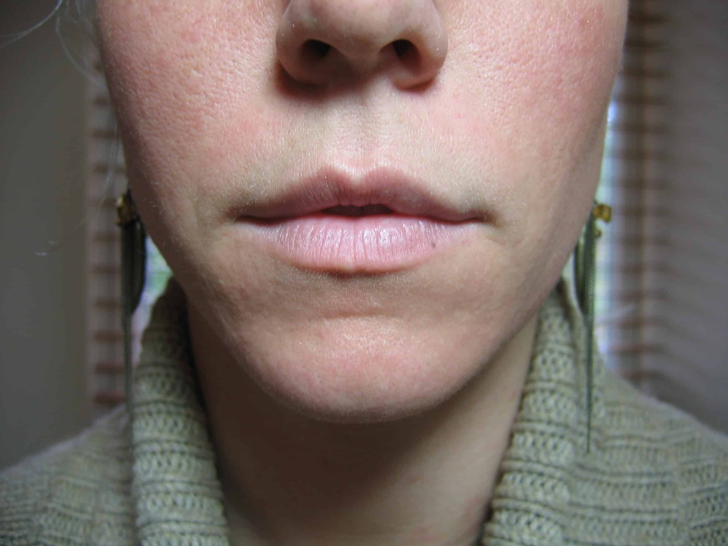 Pre Restylane 3