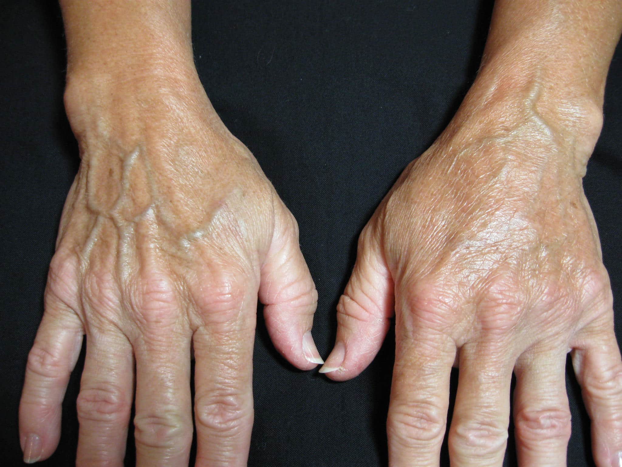 R hand not treated, left hand treated