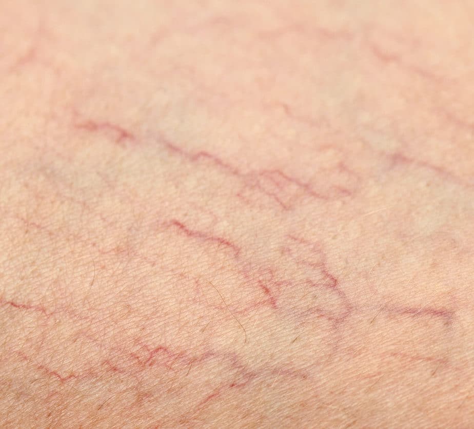 Spider Veins | AesthetiSpa