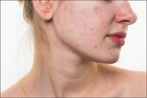 Woman showing acne prior to Celluma Treatment