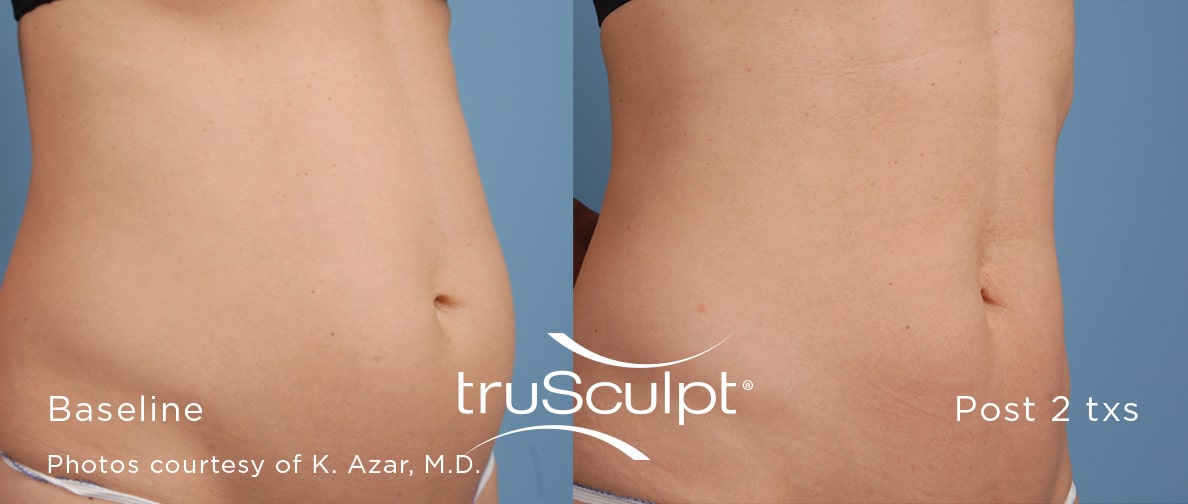 trusculpt body 1