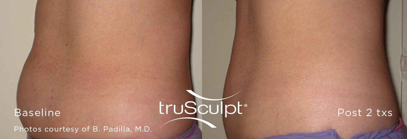 Before & After Image of TruSculpt® ID Avian Park SC