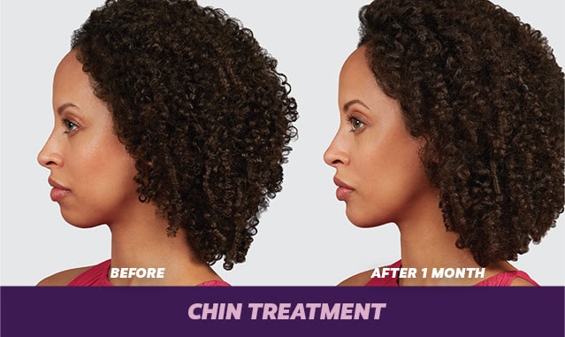 chin augmentation voluma