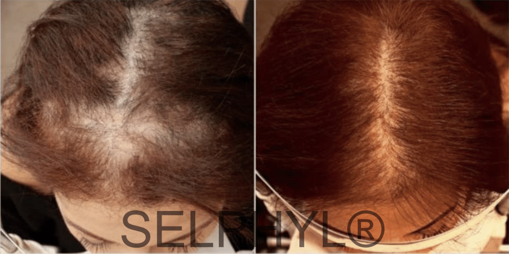 top of female patient’s head before and after acell prfm hair restoration, hair much fuller after treatment