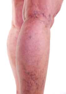 Varicose Veins stock photo