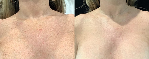 Before & After Image of IPL Treatment Mount Pleasant SC