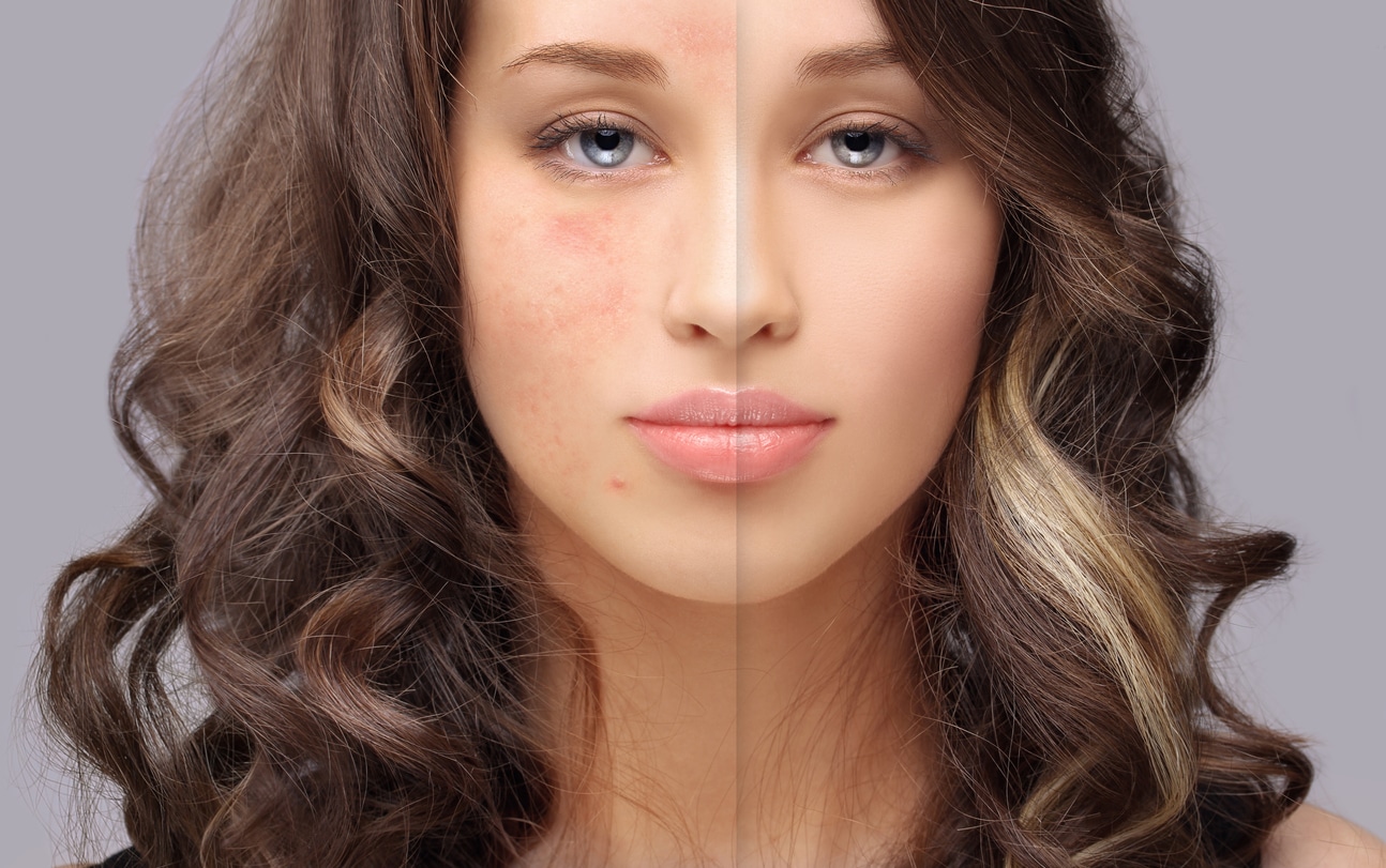 Microdermabrasion Mount Pleasant SC