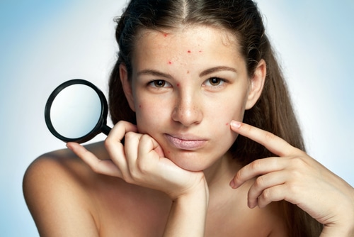 Girl with a pimply face holding magnifying glass.