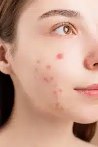 Acne treatment Acne treatment