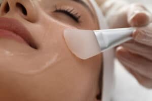 chemical peel prep