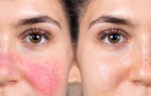 Before,And,After,Successful,Rosacea,Treatment,On,The,Face,Of
