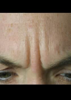 Before Image of BOTOX Avian Park SC
