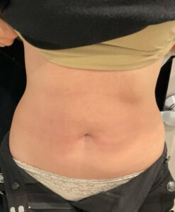 After Image: TruSculpt – Case 1
