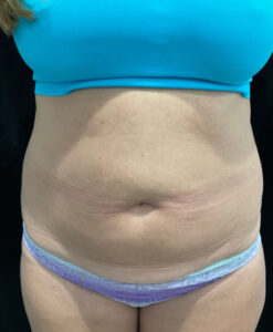 Before Image: TruSculpt – Case 1