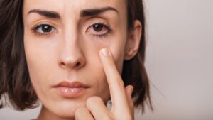 A close-up shot of a woman pointing to red, tired-looking eyes