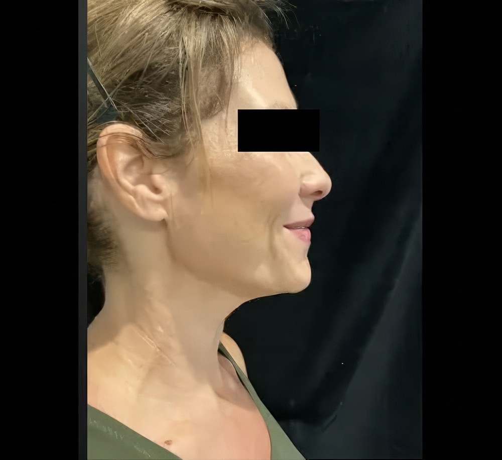After Image: Genius™ RF Neck - right-side
