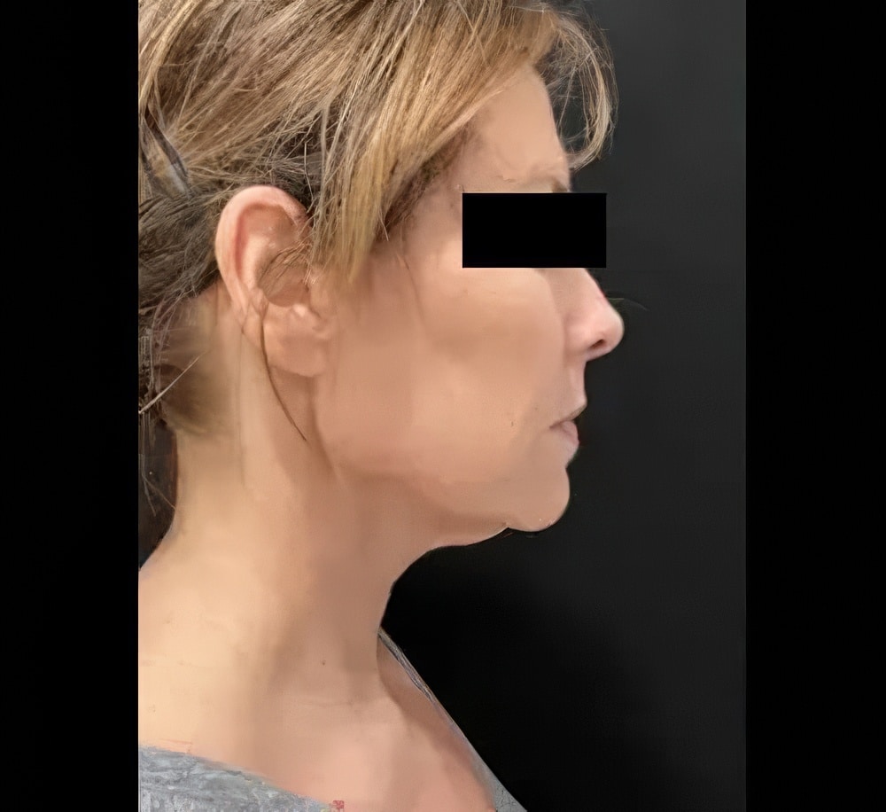 Before Image: Genius™ RF Neck - right-side
