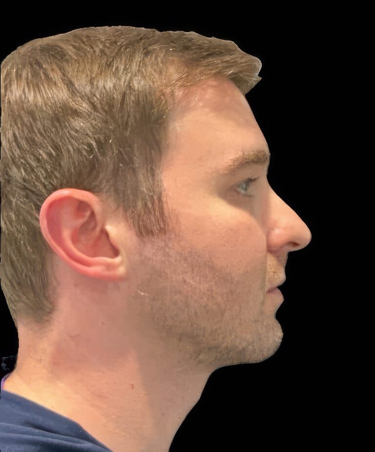 After Image: Botox & Filler - right-side