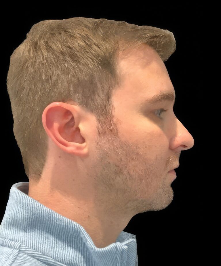 Before Image: Botox & Filler - right-side