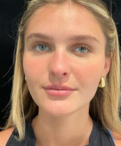 After Image: Filler