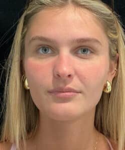 Before Image: Filler
