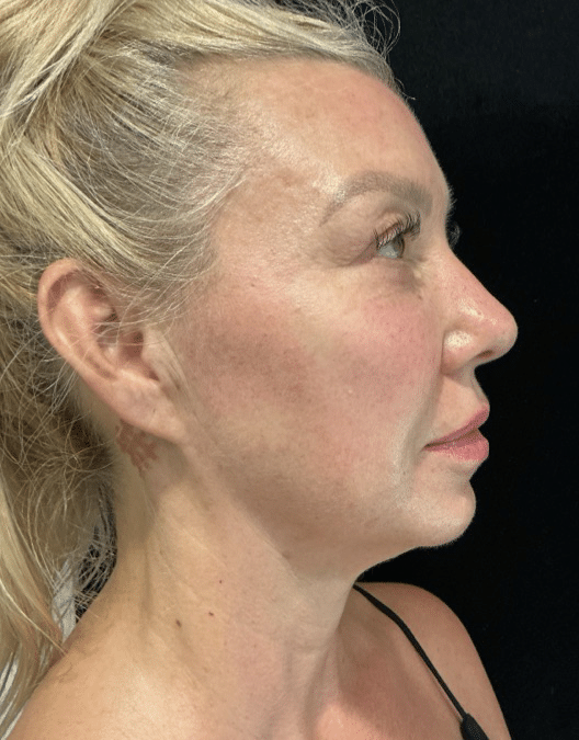 After Image: Cheek and Chin Filler - right-side
