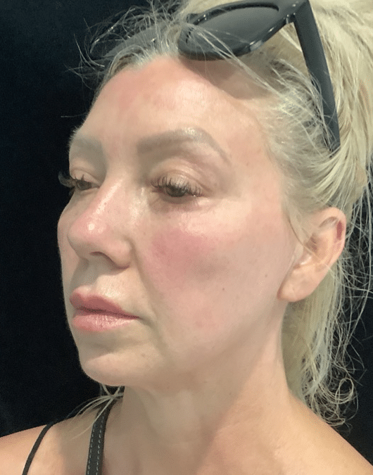 After Image: Cheek and Chin Filler - left-front-oblique