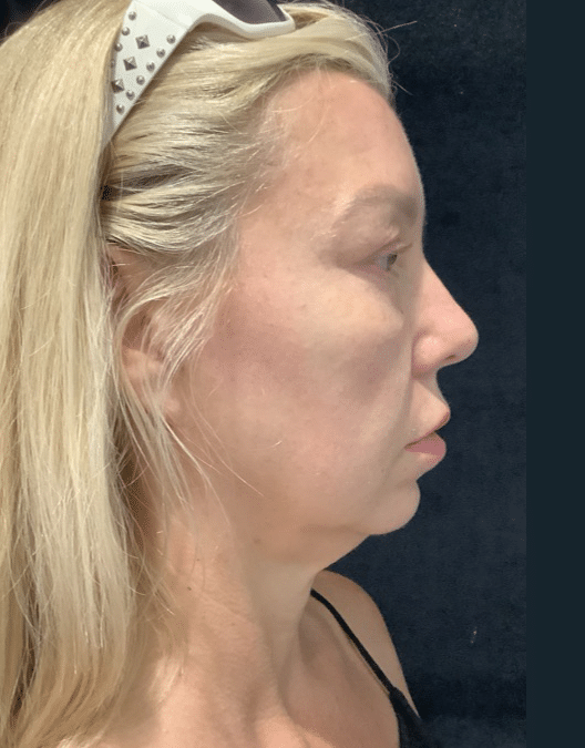 Before Image: Cheek and Chin Filler - right-side