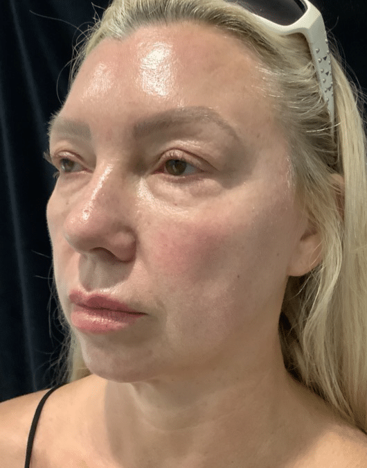 Before Image: Cheek and Chin Filler - left-front-oblique