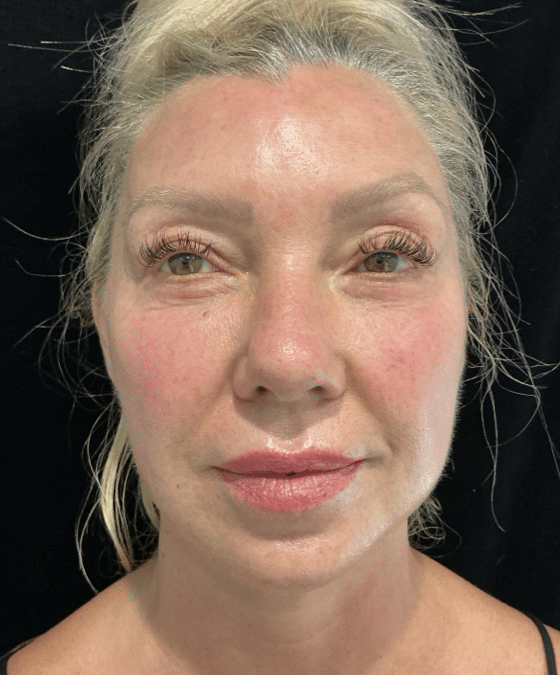 After Image: Cheek and Chin Filler - front