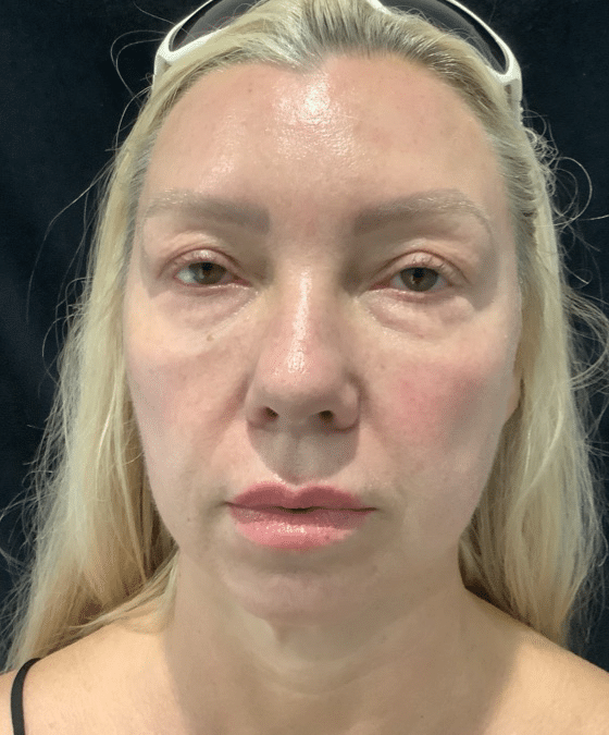 Before Image: Cheek and Chin Filler - front