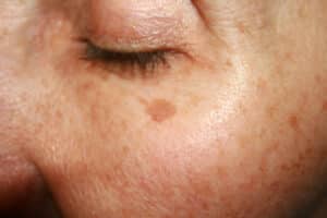 A close-up shot of sun damage on a woman's cheek