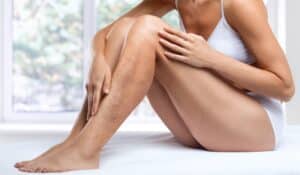 A close-up shot of spider veins on a woman's legs