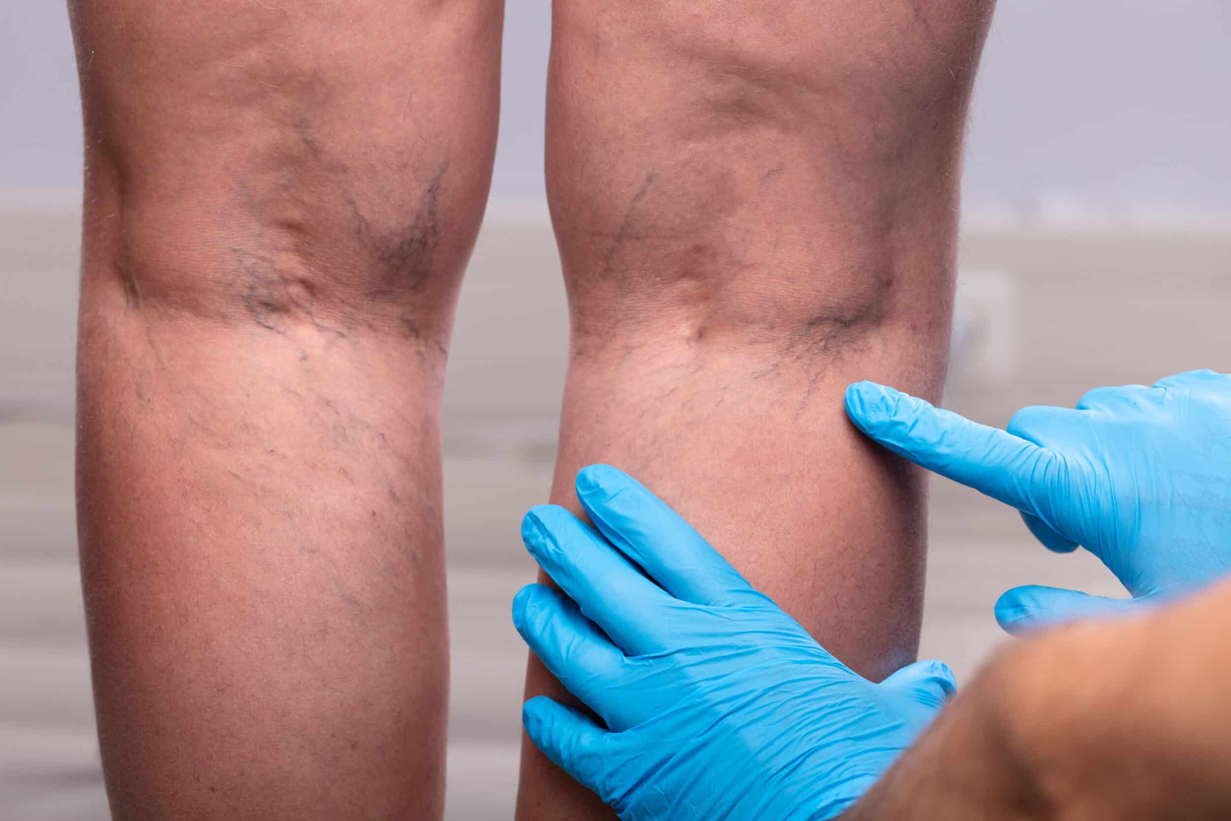 A doctor pointing to veins on a patient's legs A doctor pointing to veins on a patient's legs