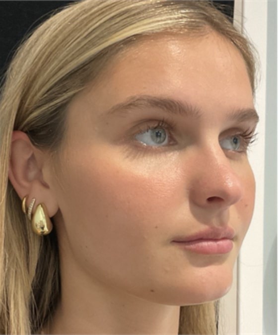 After Image: Lip Filler - right-front-oblique