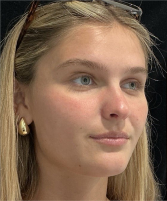 Before Image: Lip Filler - right-front-oblique