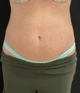 After Image: TruSculpt – Case 2