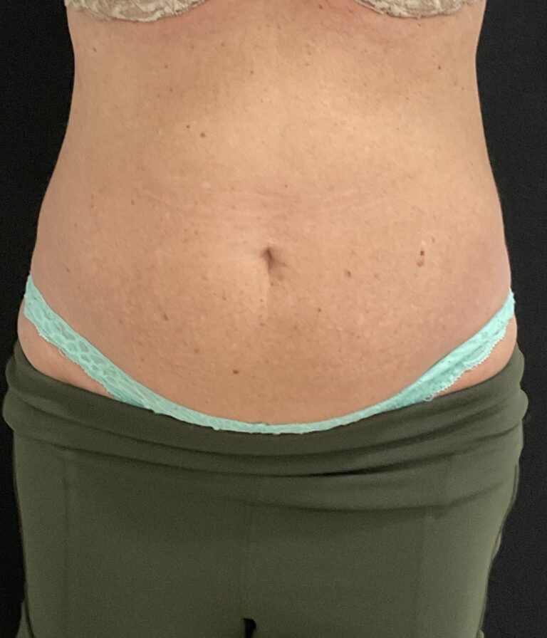 After Image: TruSculpt – Case 2 - front